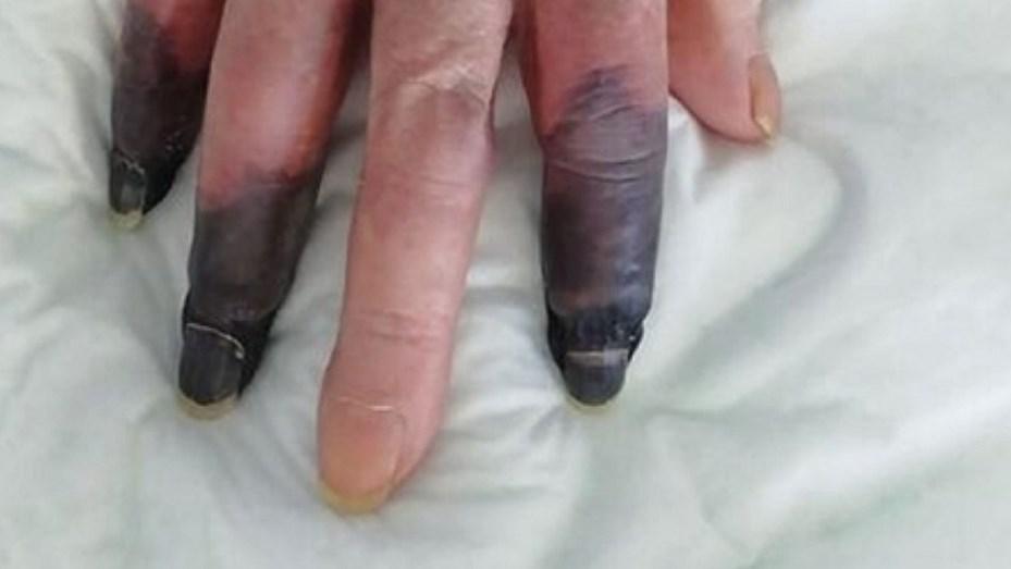 gangrena