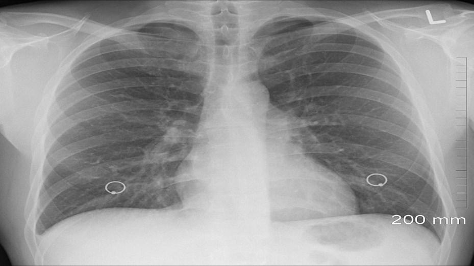 pulmones